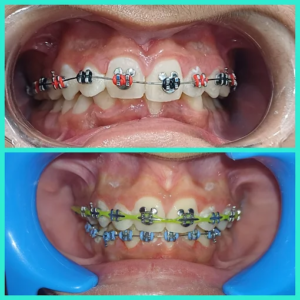 Orthognathic Surgery