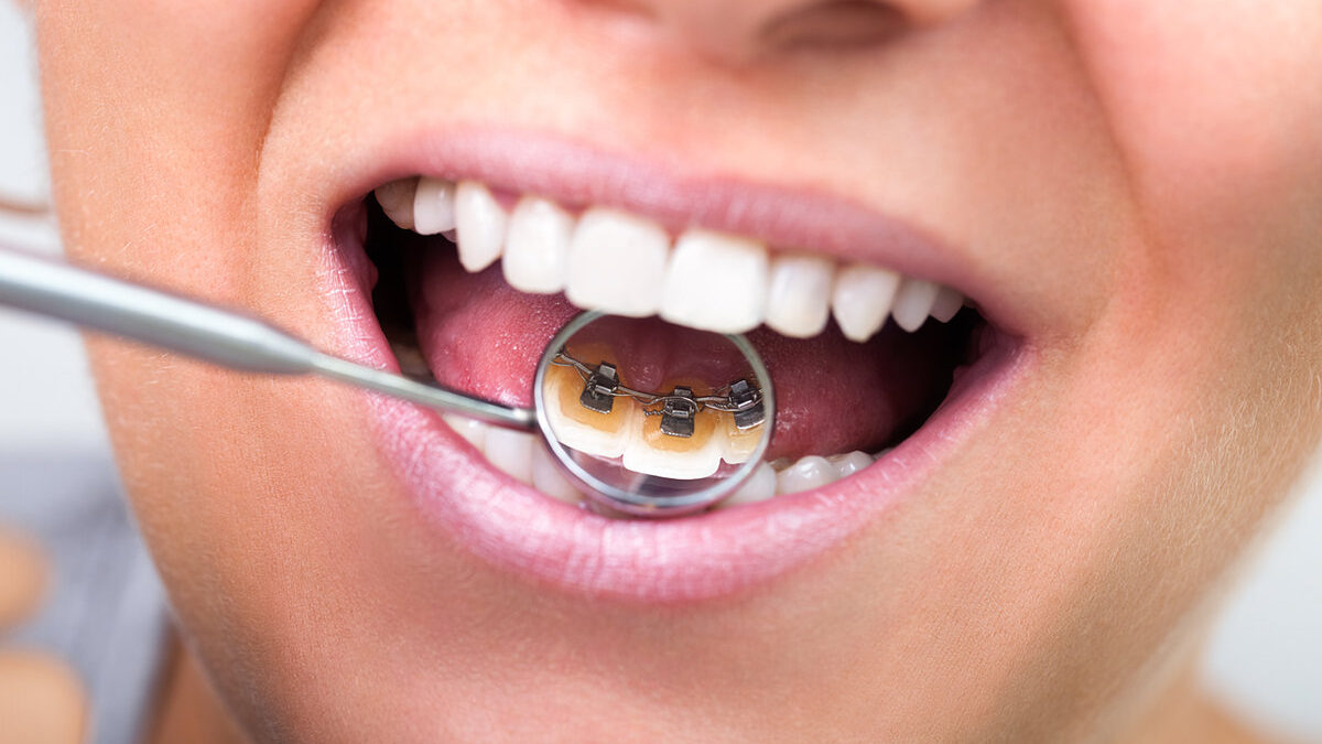 Incognito Braces