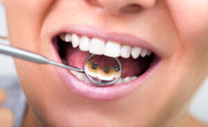 Incognito Braces