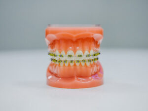 Damon Self-Ligating Braces