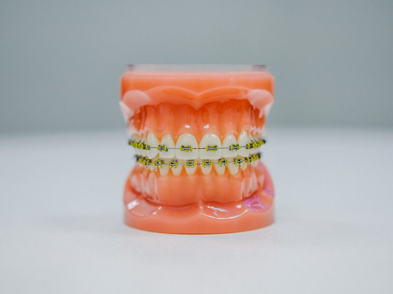 Damon Self-Ligating Braces