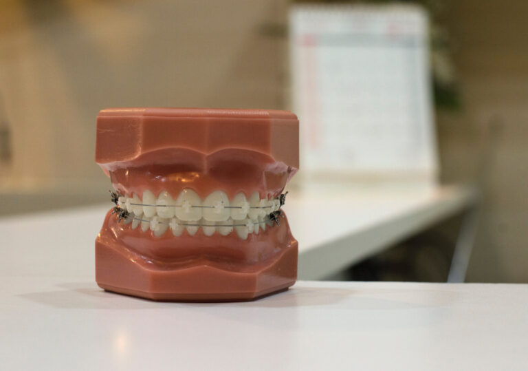 Ceramic Braces