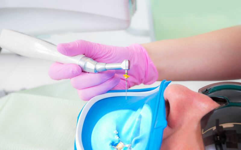 Services 13 Root Canal Treatment