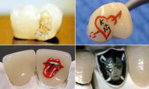 Tooth Tattoos