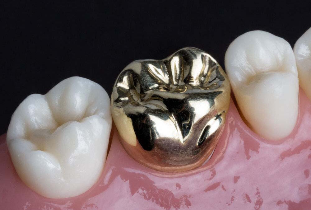 Gold Crowns