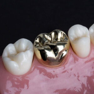 Gold Crowns
