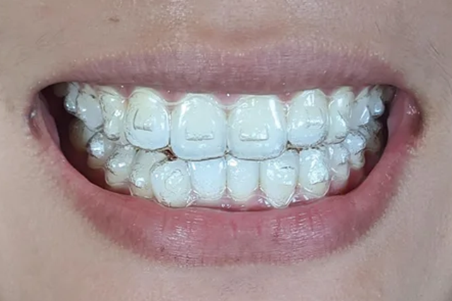 Services 19 invisalign attachments